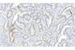 Immunohistochemical analysis of paraffin-embedded Human Lung adenocarcinoma section using Pink1 (ABIN6243980 and ABIN6577274).