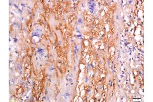 Formalin-fixed and paraffin embedded human colon carcinoma tissue labeled with Anti-sFRP-4 Polyclonal Antibody, Unconjugated  at 1:200 followed by conjugation to the secondary antibody and DAB staining.