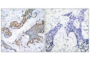 Immunohistochemical analysis of paraffin-embedded human breast carcinoma tissue using Estrogen Receptor-a(Phospho-Ser118) Antibody(left) or the same antibody preincubated with blocking peptide(right). (Estrogen Receptor alpha Antikörper  (pSer118))