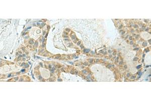 Immunohistochemistry of paraffin-embedded Human thyroid cancer tissue using KLC2 Polyclonal Antibody at dilution of 1:120(x200) (KLC2 Antikörper)