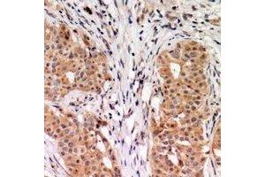 Immunohistochemical analysis of RhoGDI alpha staining in human breast cancer formalin fixed paraffin embedded tissue section. (ARHGDIA Antikörper  (C-Term))