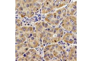 Immunohistochemical analysis of UQCR10 staining in human liver cancer formalin fixed paraffin embedded tissue section. (UQCR10 Antikörper)