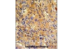 Formalin-fixed and paraffin-embedded human hepatocarcinoma with Cyclin A (CCNA2) Antibody (N-term), which was peroxidase-conjugated to the secondary antibody, followed by DAB staining. (Cyclin A Antikörper  (N-Term))