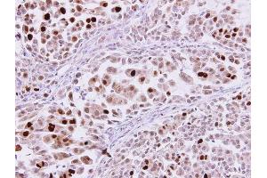 IHC-P Image karyopherin alpha 2 antibody [C3], C-term detects karyopherin alpha 2 protein at nucleus on human lung adenocarcinoma by immunohistochemical analysis. (KPNA2 Antikörper  (C-Term))