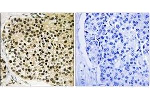 Immunohistochemistry analysis of paraffin-embedded human breast carcinoma, using NFAT3 (Phospho-Ser168+Ser170) Antibody. (NFATC4 Antikörper  (pSer168))