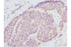 Immunohistochemistry of paraffin-embedded human gastric cancer using ABIN7151362 at dilution of 1:100 (ENOX2 Antikörper  (AA 411-610))