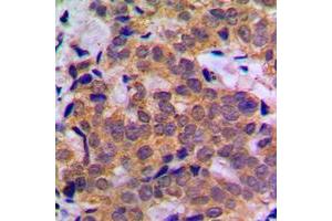 Immunohistochemical analysis of STAT5A staining in human breast cancer formalin fixed paraffin embedded tissue section.
