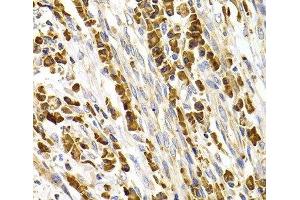 Immunohistochemistry of paraffin-embedded Human stomach cancer using TACR3 Polyclonal Antibody at dilution of 1:100 (40x lens). (TACR3 Antikörper)