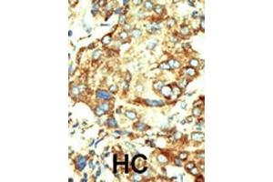 Formalin-fixed and paraffin-embedded human cancer tissue reacted with the primary antibody, which was peroxidase-conjugated to the secondary antibody, followed by DAB staining. (Dnmt2 Antikörper  (AA 346-375))