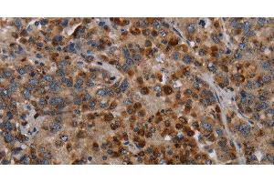 Immunohistochemistry of paraffin-embedded Human liver cancer using MAP3K11 Polyclonal Antibody at dilution of 1:40 (MAP3K11 Antikörper)