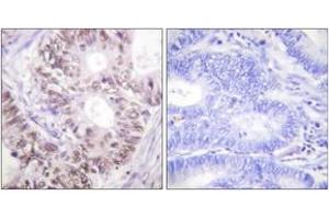 Immunohistochemistry analysis of paraffin-embedded human colon carcinoma, using CDC25C (Phospho-Thr48) Antibody. (CDC25C Antikörper  (pThr48))