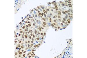 Immunohistochemistry of paraffin-embedded human lung cancer using MDC1 antibody at dilution of 1:100 (40x lens). (MDC1 Antikörper)