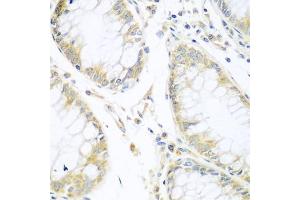 Immunohistochemistry of paraffin-embedded human gastric cancer using CUL3 antibody (ABIN5970436) at dilution of 1/100 (40x lens). (Cullin 3 Antikörper)
