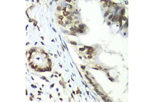 Immunohistochemistry of paraffin-embedded human liver cancer using TEAD1 antibody at dilution of 1:100 (x40 lens). (TEAD1 Antikörper)