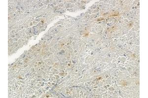 ABIN6266259 and ABIN6277418 at 1/100 staining human lung squamous cell carcinoma by IHC-P. (P2RY4 Antikörper  (C-Term))