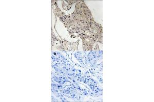 Immunohistochemical staining of human breast carcinoma tissue by GAB2 (phospho S623) polyclonal antibody  without blocking peptide (A) or preincubated with blocking peptide (B) under 1:50-1:100 dilution. (GAB2 Antikörper  (pSer623))