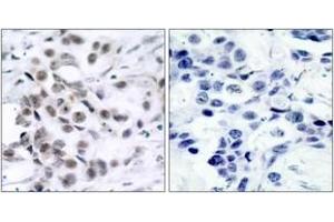 Immunohistochemistry analysis of paraffin-embedded human breast carcinoma tissue, using Chk1 (Ab-317) Antibody. (CHEK1 Antikörper  (AA 286-335))