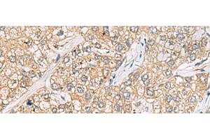 Immunohistochemistry of paraffin-embedded Human liver cancer tissue using P3H2 Polyclonal Antibody at dilution of 1:30(x200) (LEPREL1 Antikörper)