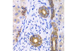 Immunohistochemistry of paraffin-embedded human liver cancer using KRT19 antibody. (Cytokeratin 19 Antikörper)