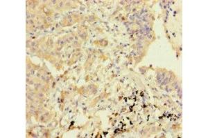Immunohistochemistry of paraffin-embedded human lung cancer using ABIN7154785 at dilution of 1:100 (GBP6 Antikörper  (AA 401-600))