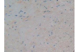 IHC-P analysis of Human Prostate Cancer Tissue, with DAB staining. (AZGP1 Antikörper)