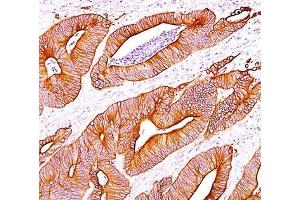 IHC staining of colon carcinoma with pan Cytokeratin antibody cocktail AE1 + AE3. (pan Keratin Antikörper)
