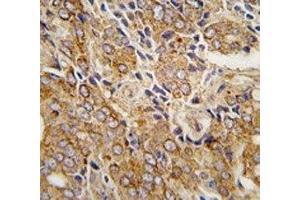 IHC analysis of FFPE human prostate carcinoma tissue stained with TRPM8 antibody (TRPM8 Antikörper  (AA 926-956))