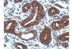 IHC-P Image Immunohistochemical analysis of paraffin-embedded human colon carcinoma, using TIE1, antibody at 1:500 dilution.