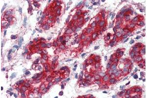 Human Breast (formalin-fixed, paraffin-embedded) stained with SOD2 antibody ABIN396955 at 1:50 followed by biotinylated anti-mouse IgG secondary antibody ABIN481714, alkaline phosphatase-streptavidin and chromogen. (SOD2 Antikörper)