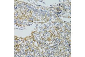 Immunohistochemistry of paraffin-embedded human gastric cancer using CHMP4B antibody (ABIN4903276) at dilution of 1:100 (40x lens). (CHMP4B Antikörper)