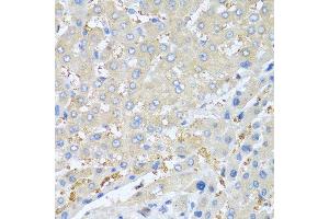 Immunohistochemistry of paraffin-embedded human liver cancer using PPBP antibody at dilution of 1:100 (40x lens). (CXCL7 Antikörper)