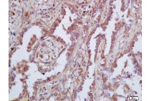 Formalin-fixed and paraffin embedded human lung carcinoma  labeled with Rabbit Anti-GAS 6 Polyclonal Antibody, Unconjugated (ABIN873146) at 1:200 followed by conjugation to the secondary antibody and DAB staining (GAS6 Antikörper  (AA 551-650))