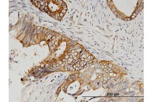 Immunoperoxidase of monoclonal antibody to SERBP1 on formalin-fixed paraffin-embedded human pancreatic cancer.