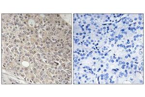 Immunohistochemistry analysis of paraffin-embedded human prostate carcinoma tissue using AMOTL1 antibody. (AMOTL1 Antikörper  (Internal Region))