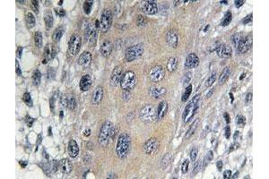 Immunohistochemical analysis of paraffin-embedded human cervix cancer tissue using COPZ1 polyclonal antibody .