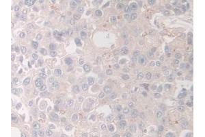 Detection of HPS4 in Human Prostate cancer Tissue using Polyclonal Antibody to Hermansky Pudlak Syndrome Protein 4 (HPS4) (HPS4 Antikörper  (AA 6-192))