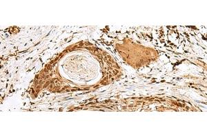 Immunohistochemistry of paraffin-embedded Human esophagus cancer tissue using SNAPC1 Polyclonal Antibody at dilution of 1:40(x200) (SNAPC1 Antikörper)