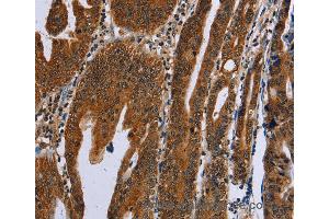 Immunohistochemistry of Human gastric cancer using GH2 Polyclonal Antibody at dilution of 1:60 (Growth Hormone 2 Antikörper)