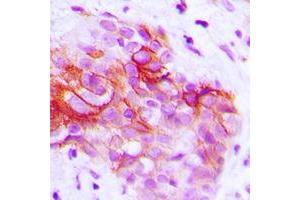 Immunohistochemical analysis of CD9 staining in human prostate cancer formalin fixed paraffin embedded tissue section. (CD9 Antikörper  (Center))