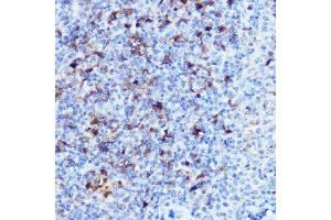 Immunohistochemistry of paraffin-embedded human liver cancer using NF-kB p65/RelA Rabbit pAb (ABIN6131885, ABIN6146861, ABIN6146863 and ABIN6215108) at dilution of 1:200 (40x lens). (NF-kB p65 Antikörper  (AA 1-200))