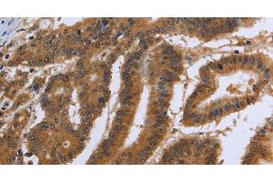 Immunohistochemistry of paraffin-embedded Human colon cancer using DUSP8 Polyclonal Antibody at dilution of 1:30 (DUSP8 Antikörper)