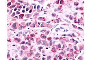 Anti-PTGER1 / EP1 antibody IHC of human Skin, Melanoma. (PTGER1 Antikörper  (Cytoplasmic Domain))
