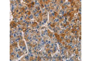 Immunohistochemistry of Human thyroid cancer using CST4 Polyclonal Antibody at dilution of 1:60