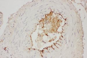 Anti- Adiponectin antibody, IHC(P) IHC(P): Human Mammary Cancer Tissue