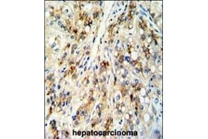 Formalin-fixed and paraffin-embedded human hepatocarcinoma reacted with CECR5 Antibody (Center), which was peroxidase-conjugated to the secondary antibody, followed by DAB staining. (CECR5 Antikörper  (AA 164-190))