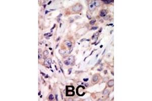 Formalin-fixed and paraffin-embedded human cancer tissue reacted with the primary antibody, which was peroxidase-conjugated to the secondary antibody, followed by DAB staining. (ROR2 Antikörper  (C-Term))