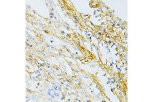 Immunohistochemistry of paraffin-embedded human lung cancer using TGFBI antibody. (TGFBI Antikörper  (AA 481-683))