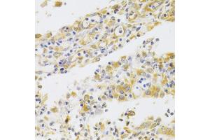 Immunohistochemistry of paraffin-embedded human gastric cancer using PA2G4 Antibody (ABIN1876564) at dilution of 1:100 (40x lens). (PA2G4 Antikörper)