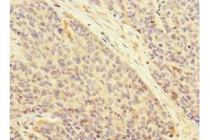 Immunohistochemistry of paraffin-embedded human ovarian cancer using ABIN7145065 at dilution of 1:100 (Attractin Antikörper  (AA 84-350))