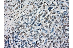 Immunohistochemical staining of paraffin-embedded Adenocarcinoma of ovary tissue using anti-MAP2K4mouse monoclonal antibody. (MAP2K4 Antikörper)